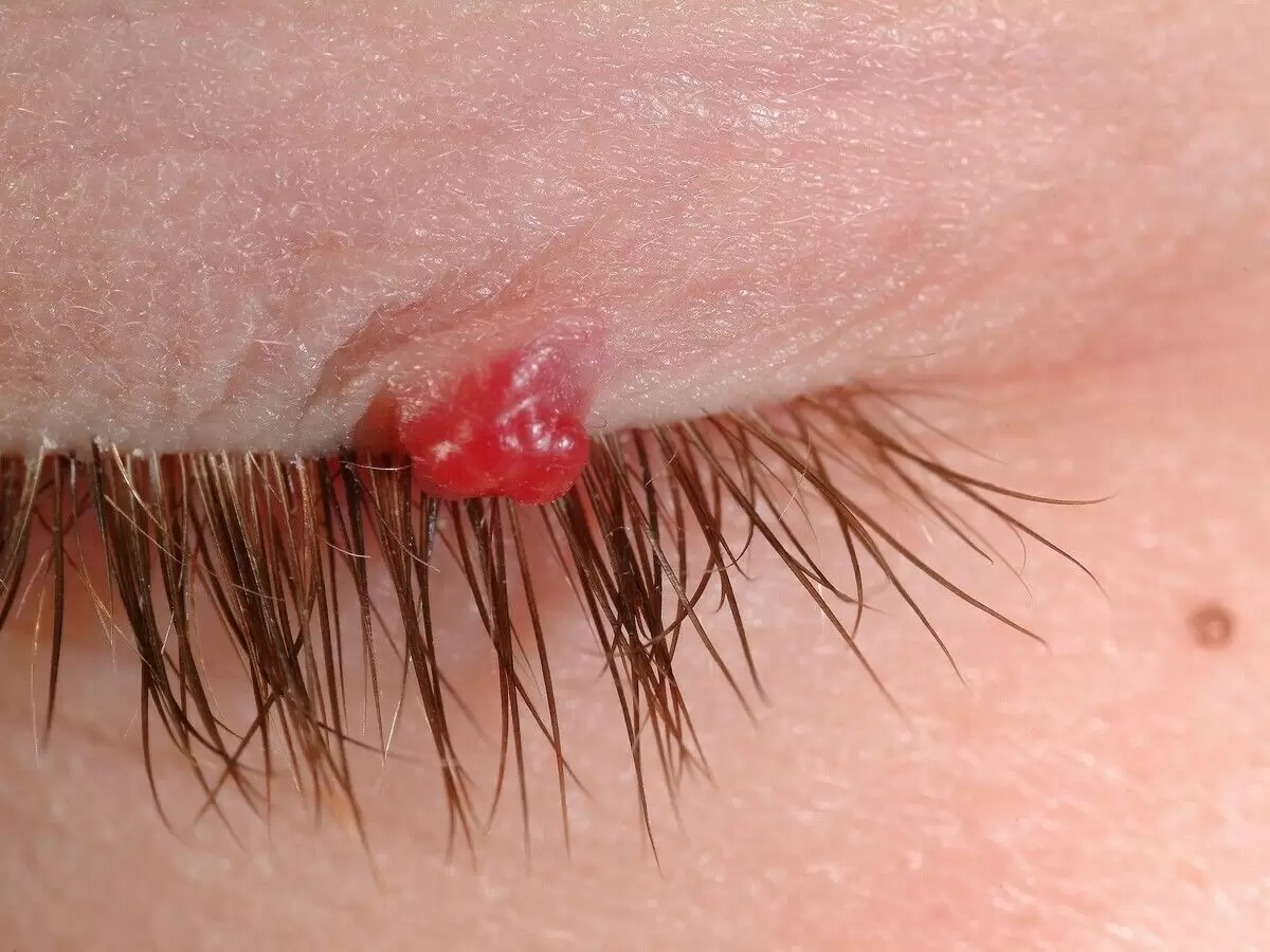 انواع همانژیوم چشم